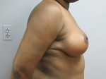 Breast Reduction