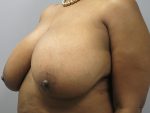 Breast Reduction