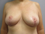 Breast Reduction