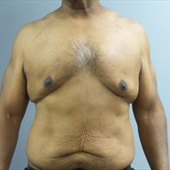Male Breast Reduction / Gynecomastia