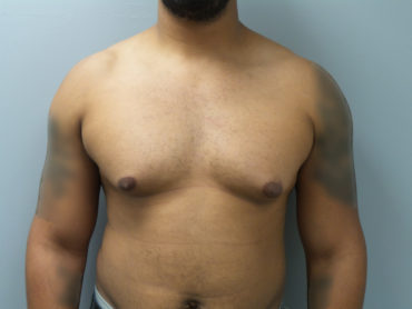 Male Breast Reduction / Gynecomastia