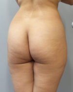 Butt Implants