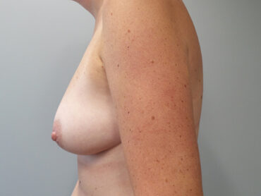 Breast Augmentation with Fat Grafting