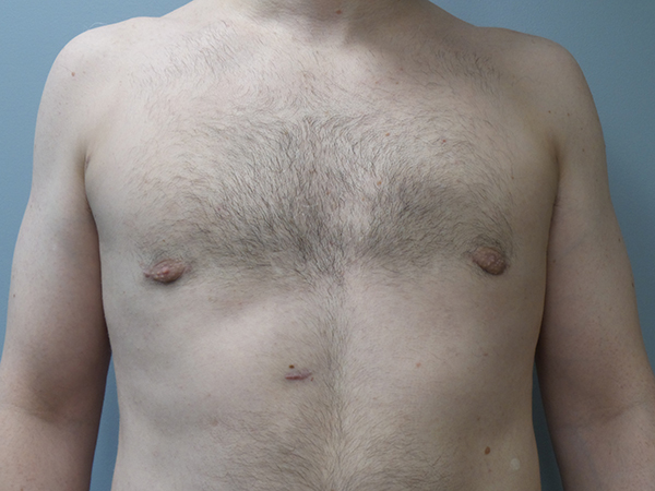 Male Breast Reduction / Gynecomastia