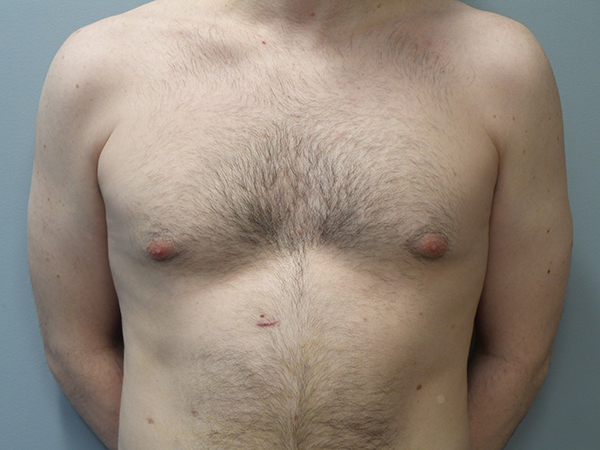 Male Breast Reduction / Gynecomastia
