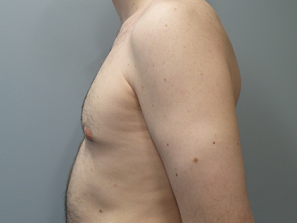 Male Breast Reduction / Gynecomastia