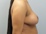 Breast Reduction