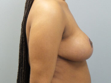 Breast Reduction