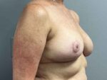 Breast Reduction