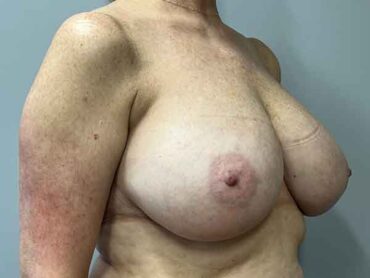 Breast Reduction