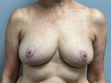 Breast Reduction