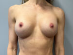 Breast Implant Exchange