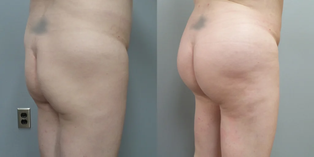 Brazilian Butt Lift Before and After Photo by Dr. Hoffman in Wynnewood Pennsylvania 008 1