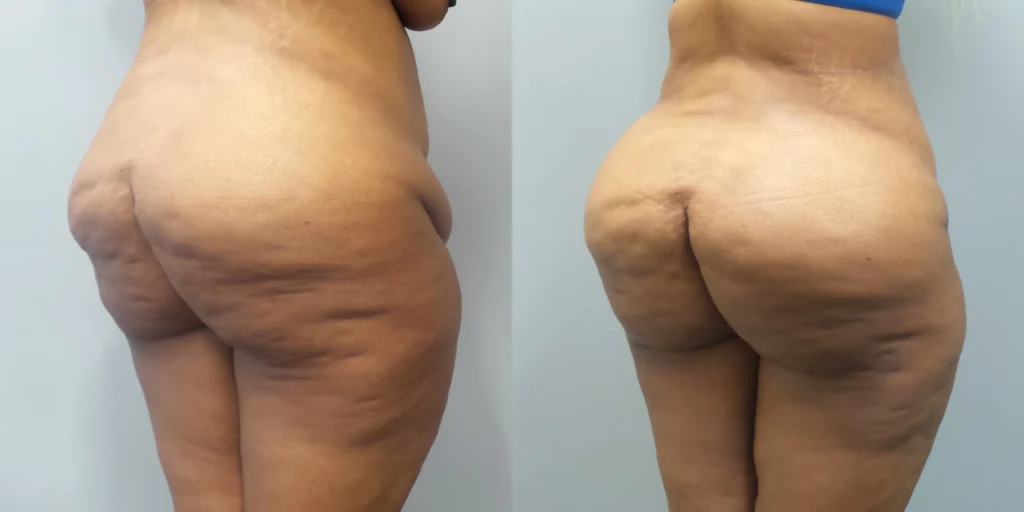 Brazilian Butt Lift Before and After Photo by Dr. Hoffman in Wynnewood Pennsylvania 009 1