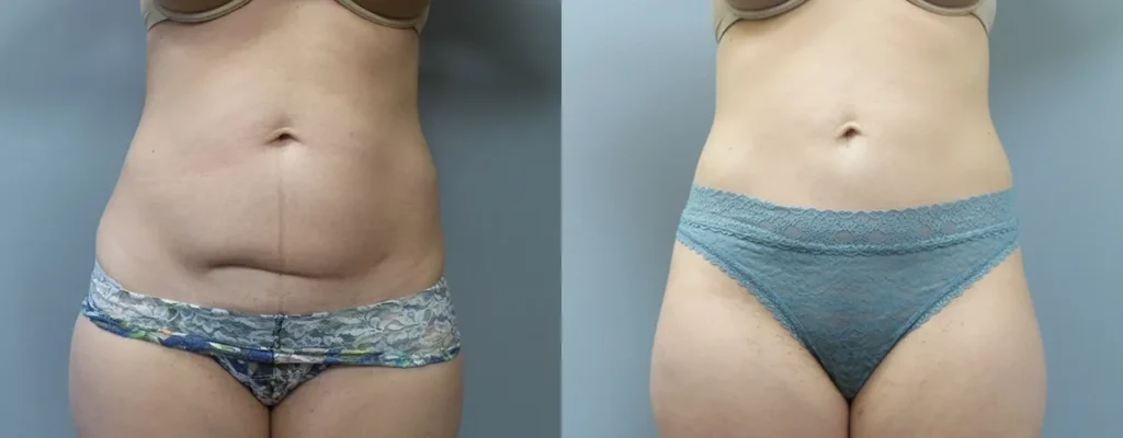 Liposuction Before and After Photo by Dr. Hoffman in Wynnewood Pennsylvania 002 1