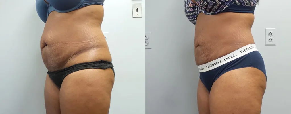 Liposuction Before and After Photo by Dr. Hoffman in Wynnewood Pennsylvania 003 1