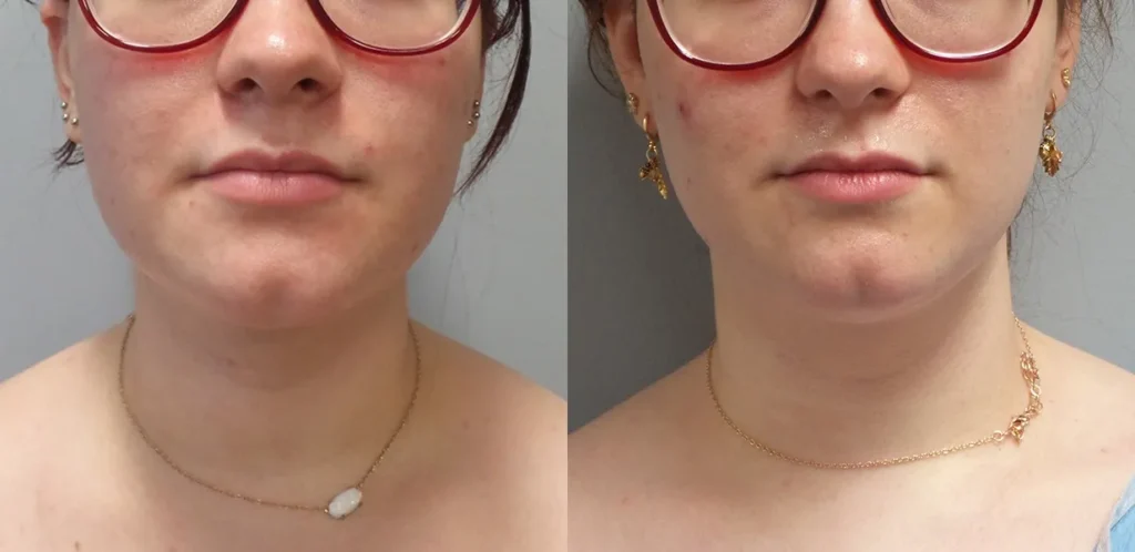 Liposuction Before and After Photo by Dr. Hoffman in Wynnewood Pennsylvania 004 1