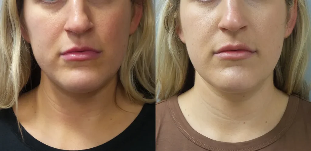 Liposuction Before and After Photo by Dr. Hoffman in Wynnewood Pennsylvania 006 1