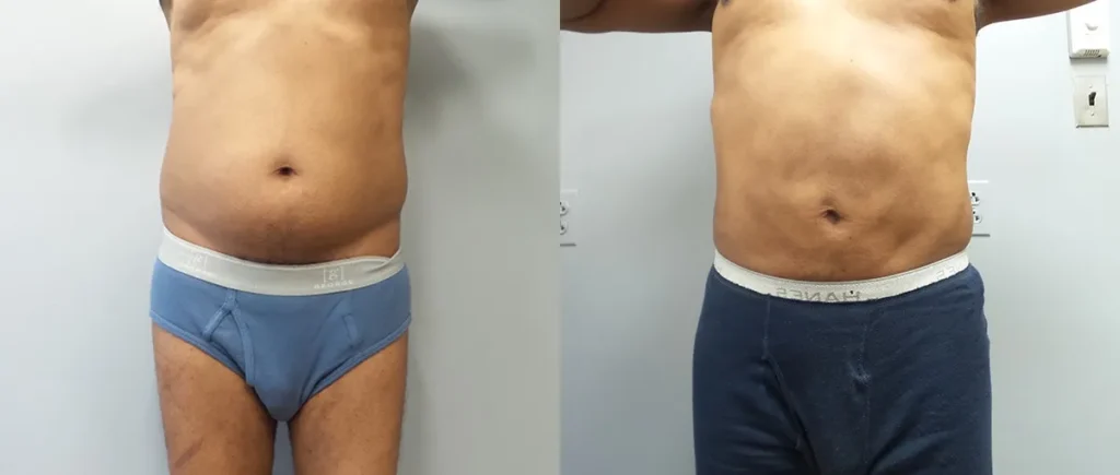 Liposuction Before and After Photo by Dr. Hoffman in Wynnewood Pennsylvania 007 1
