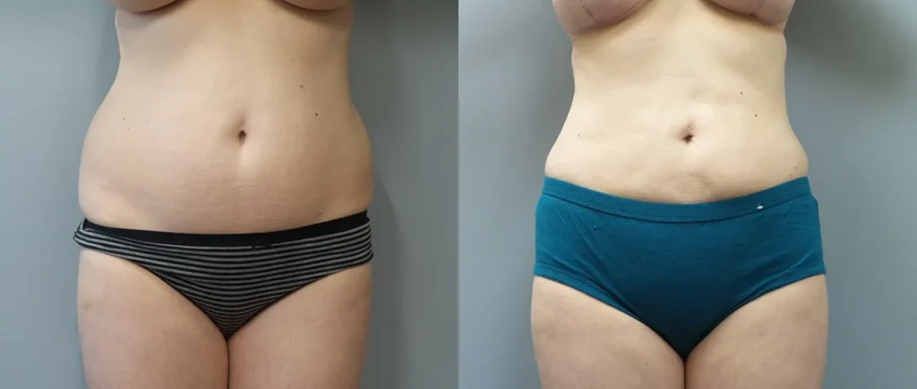 Liposuction Before and After Photo by Dr. Hoffman in Wynnewood Pennsylvania 008 1