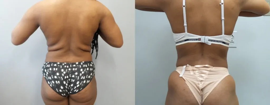 Liposuction Before and After Photo by Dr. Hoffman in Wynnewood Pennsylvania 009 1