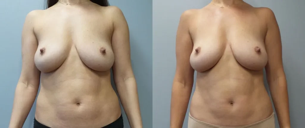 Beautifill Before and After Photo by Dr. Hoffman in Wynnewood Pennsylvania 002 1
