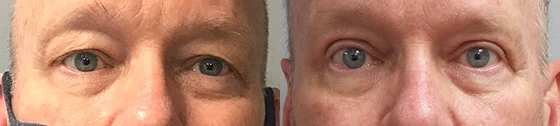 Blepharoplasty Before and After Photo by Dr. Hoffman in Wynnewood Pennsylvania