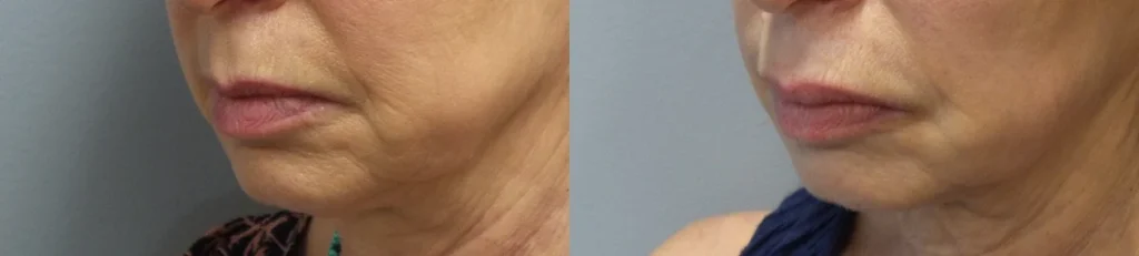 Facial fillers Before and After Photo by Dr. Hoffman in Wynnewood Pennsylvania