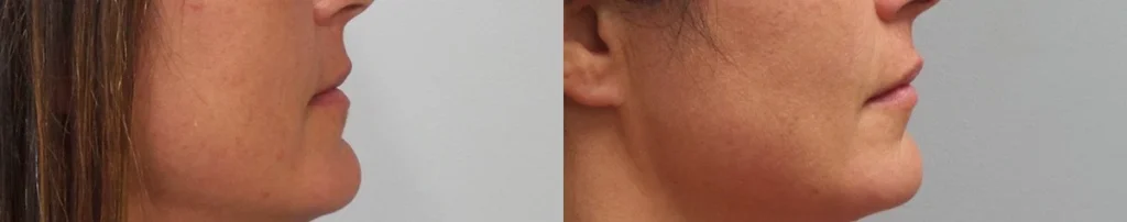 Facial fillers Before and After Photo by Dr. Hoffman in Wynnewood Pennsylvania