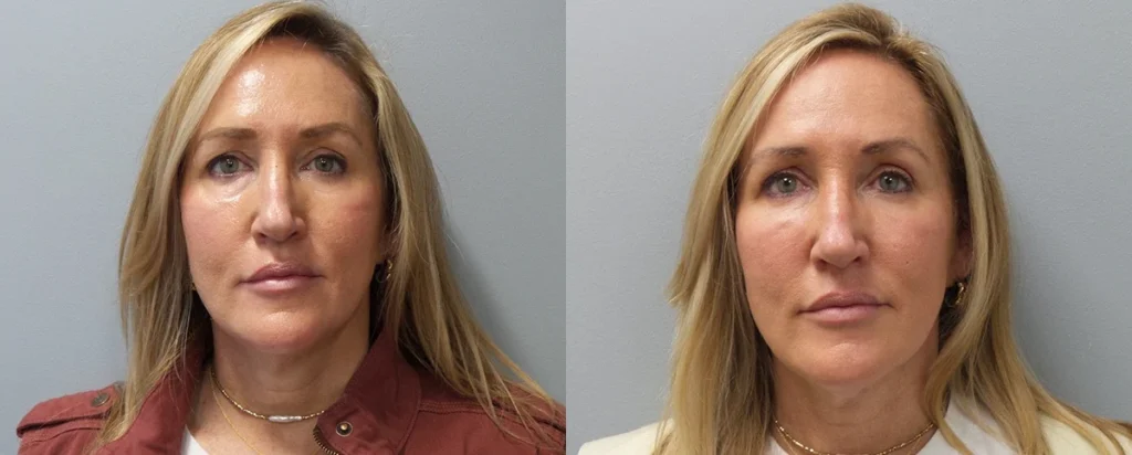 Facial fillers Before and After Photo by Dr. Hoffman in Wynnewood Pennsylvania