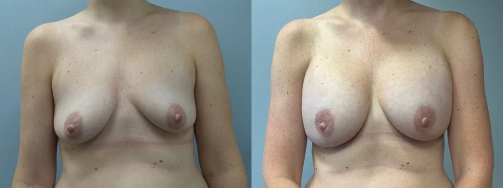 Breast Augmentation Before and After Photo by Dr. Hoffman in Wynnewood Pennsylvania