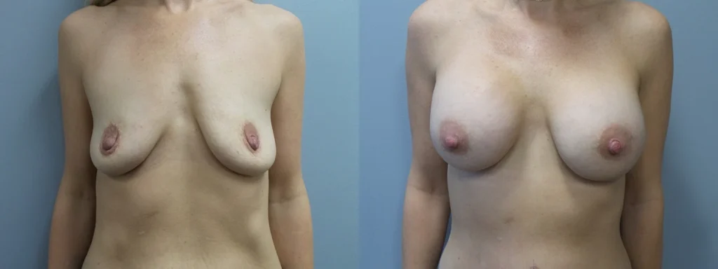 Breast Augmentation Before and After Photo by Dr. Hoffman in Wynnewood Pennsylvania