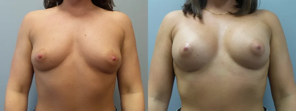 Breast Augmentation Before and After Photo by Dr. Hoffman in Wynnewood Pennsylvania
