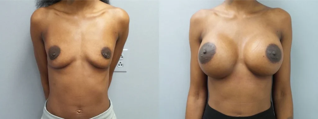 Breast Augmentation Before and After Photo by Dr. Hoffman in Wynnewood Pennsylvania