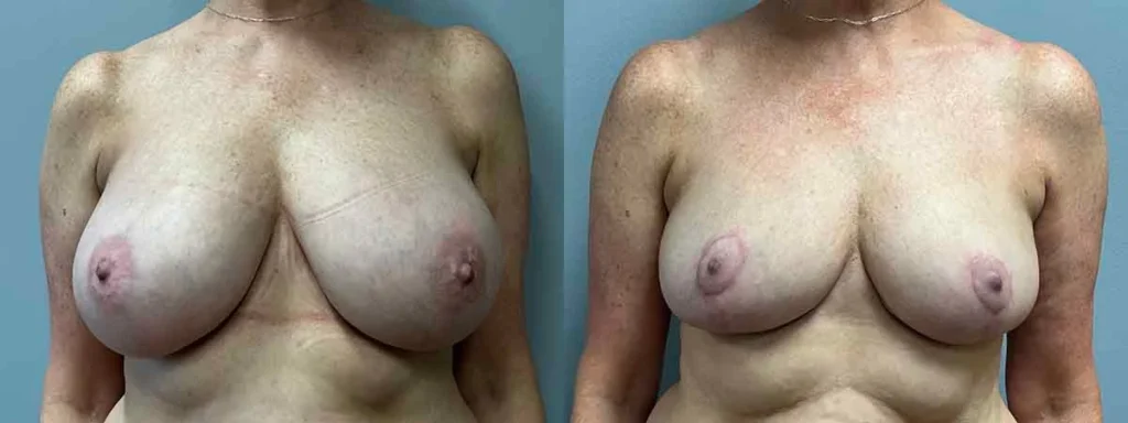 Breast Reduction Before and After Photo by Dr. Hoffman in Wynnewood Pennsylvania
