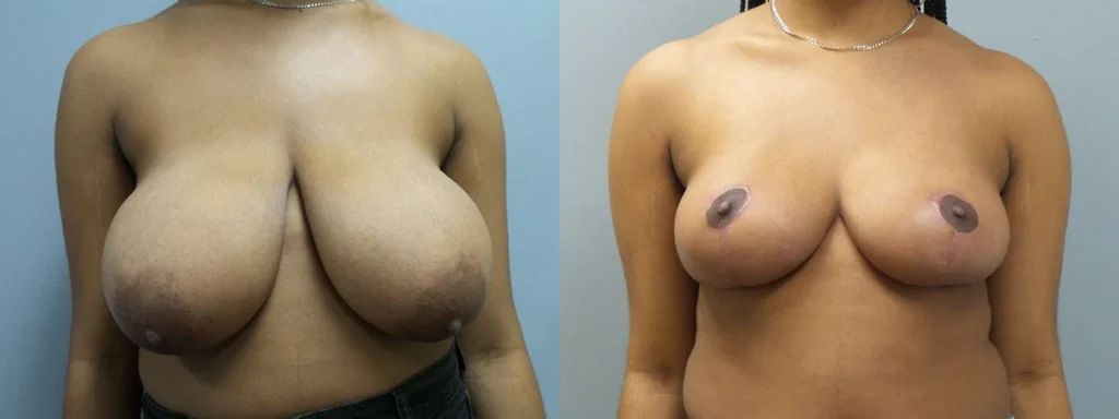 Breast Reduction Before and After Photo by Dr. Hoffman in Wynnewood Pennsylvania