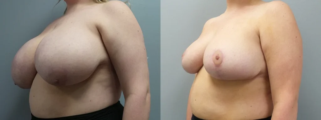 Breast Reduction Before and After Photo by Dr. Hoffman in Wynnewood Pennsylvania
