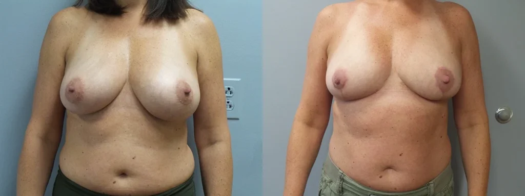 Breast Reduction Before and After Photo by Dr. Hoffman in Wynnewood Pennsylvania