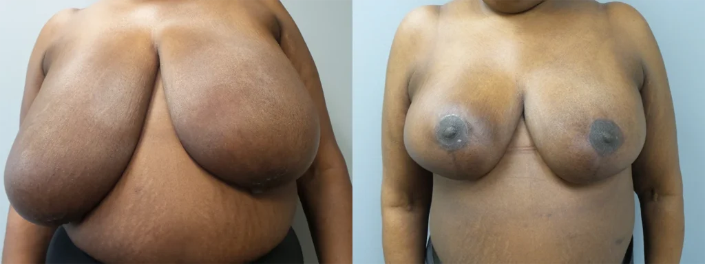 Breast Reduction Before and After Photo by Dr. Hoffman in Wynnewood Pennsylvania