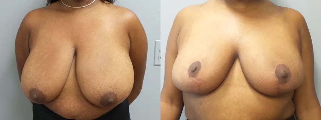 Breast Reduction Before and After Photo by Dr. Hoffman in Wynnewood Pennsylvania