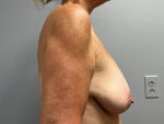 Breast Lift