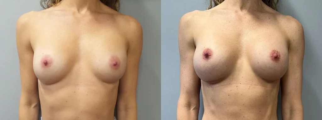 Breast Implant Exchange Before and After Photo by Dr. Hoffman in Wynnewood Pennsylvania 001 1