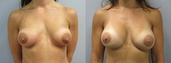 Breast Implant Exchange Before and After Photo by Dr. Hoffman in Wynnewood Pennsylvania 003 1