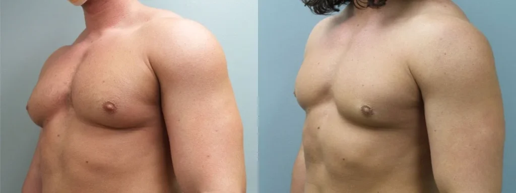 Male Breast Reduction Before and After Photo by Dr. Hoffman in Wynnewood Pennsylvania