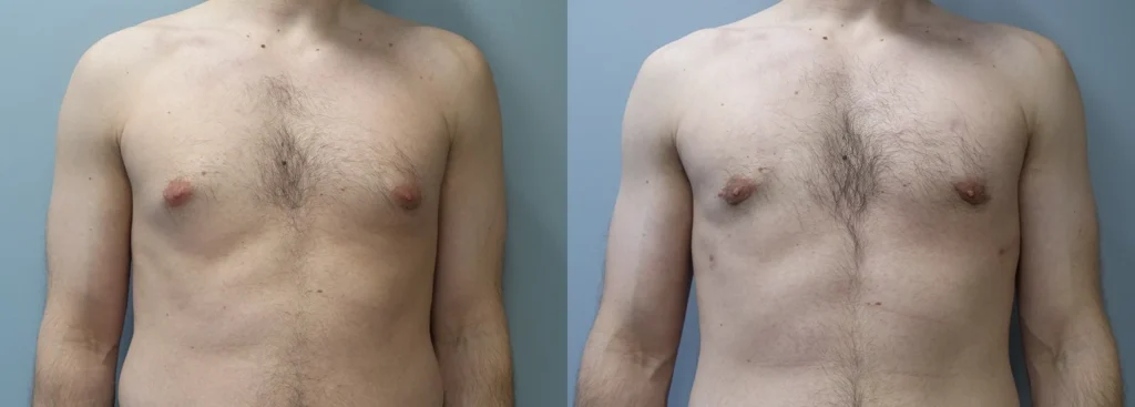 Male Breast Reduction Before and After Photo by Dr. Hoffman in Wynnewood Pennsylvania