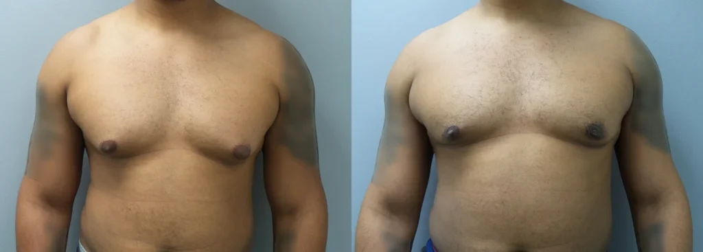 Male Breast Reduction Before and After Photo by Dr. Hoffman in Wynnewood Pennsylvania