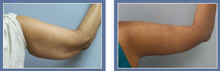 Brachioplasty/Arm Lift Before and After Photo Philadelphia
