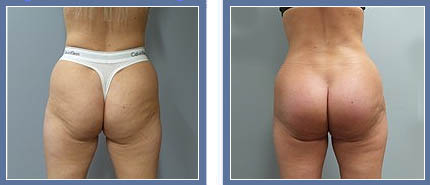 Buttock Enhancement Before and After Photo