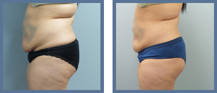 Liposuction Before and After Photo Philadelphia