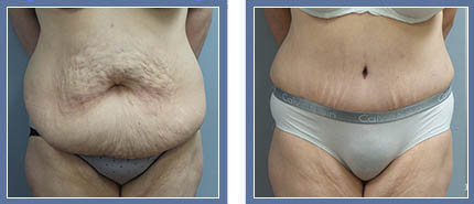 Abdominoplasty Before and After Photo